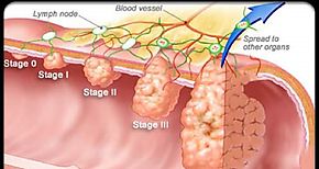 Hallan en los tejidos del colon un marcador tumoral