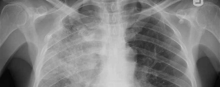 Suman 62 contagiados por extraa epidemia de neumona en China