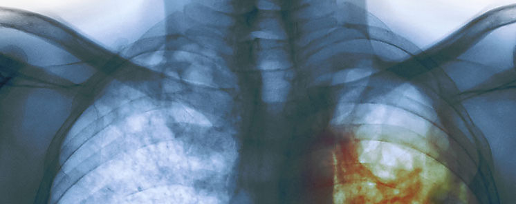 Inteligencia artificial puede detectar tuberculosis en radiografas