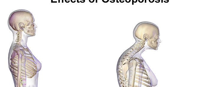 Da Mundial de la Osteoporosis