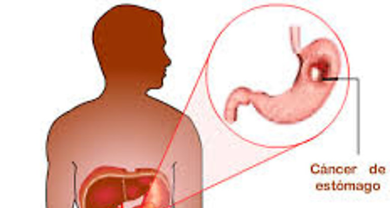 cancer  gastrico