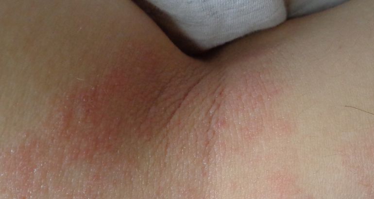 Dermatitis atpica