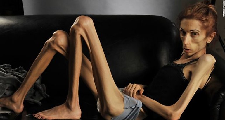 Anorexia