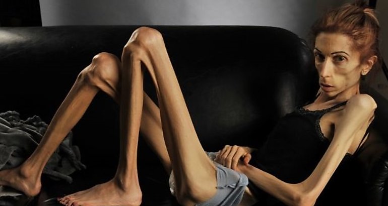 Anorexia nerviosa