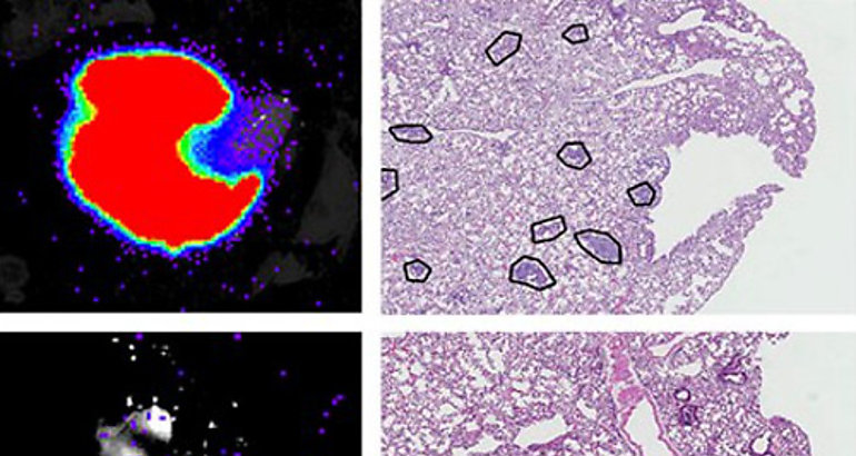 Descubierta una protena clave en la metstasis tumoral