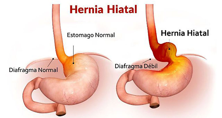 Las hernias ms comunes se desarrollan en el abdomen 