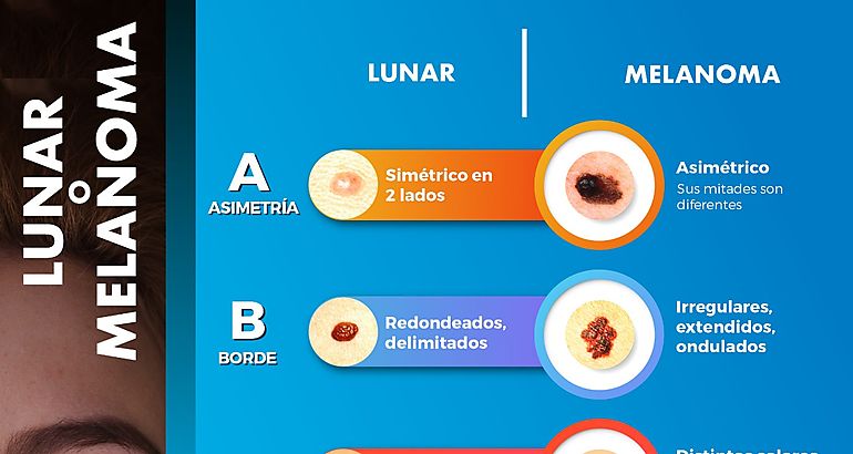 El melanoma es el cncer de piel ms agresivo que existe y se puede confundir con un lunar la mejor herramienta es la deteccin temprana